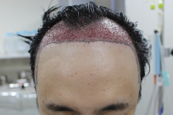 수술후