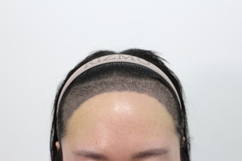 수술 후 2주차