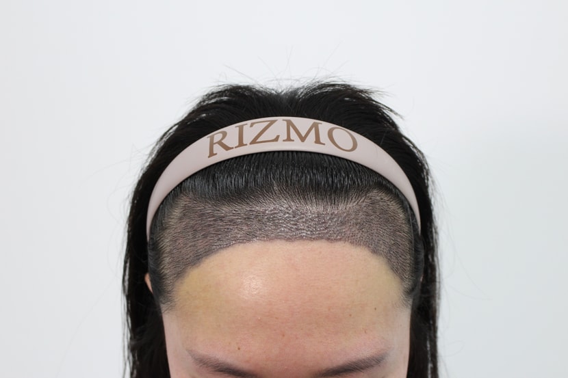 수술 후 2주차