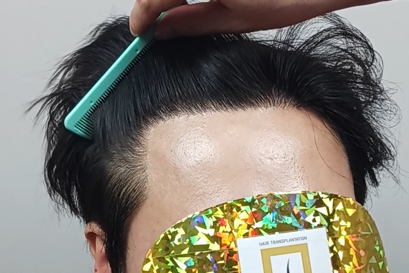 모나라피부과_모발이식1년 (2).jpg