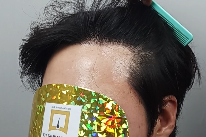 모나라피부과_모발이식1년 (3).jpg