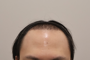 수술후1개월경과