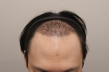 수술후1개월경과