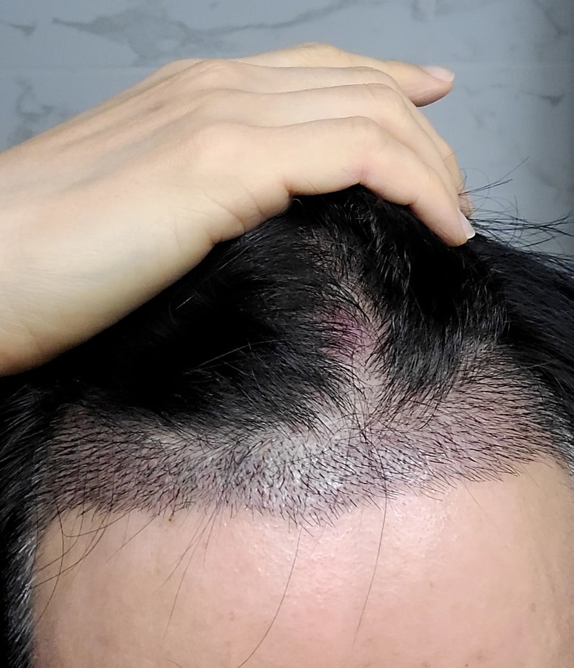 수술후 2주차