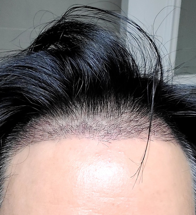 수술후 3주차