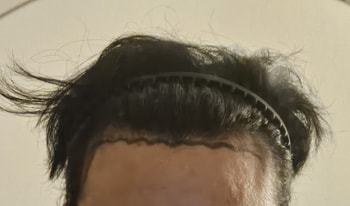 모발이식전