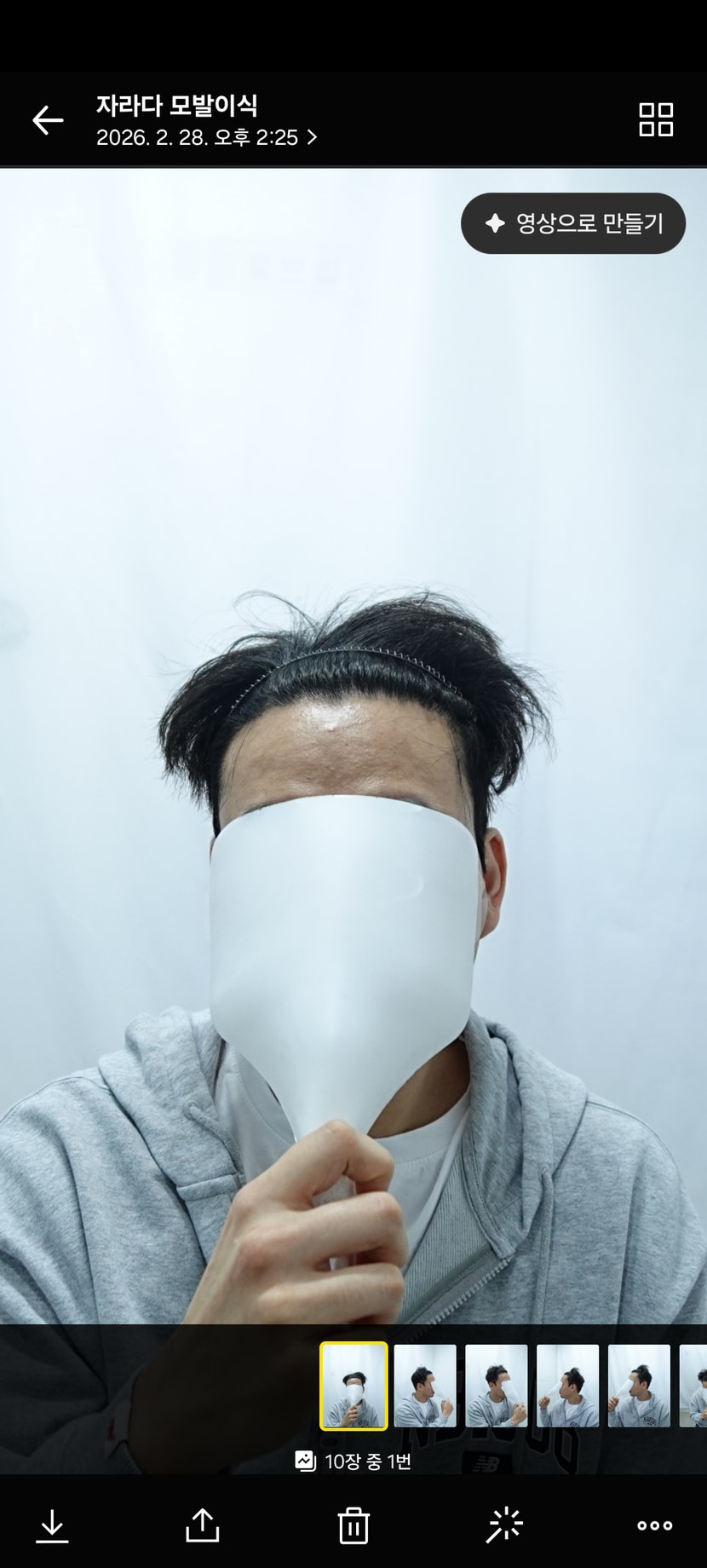 모발이식9개월