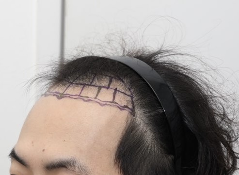 수술전