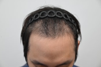 수술 전