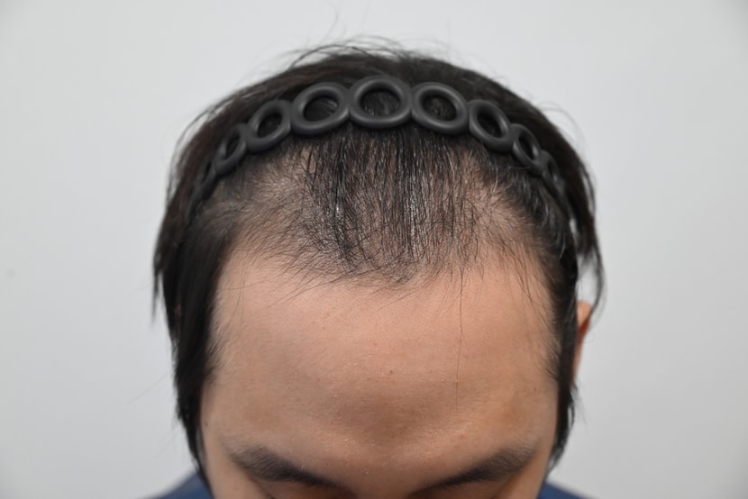 수술 전
