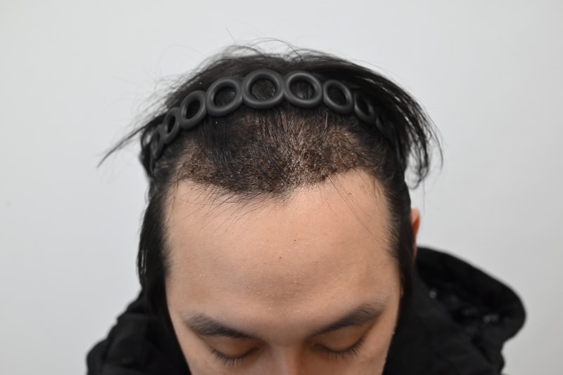 수술 후.jpg
