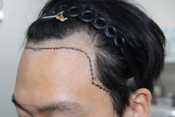수술전