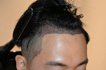 수술후 2일차