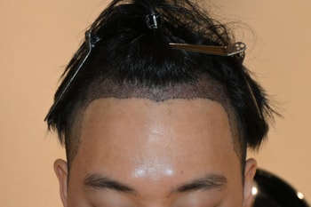수술후 2일차