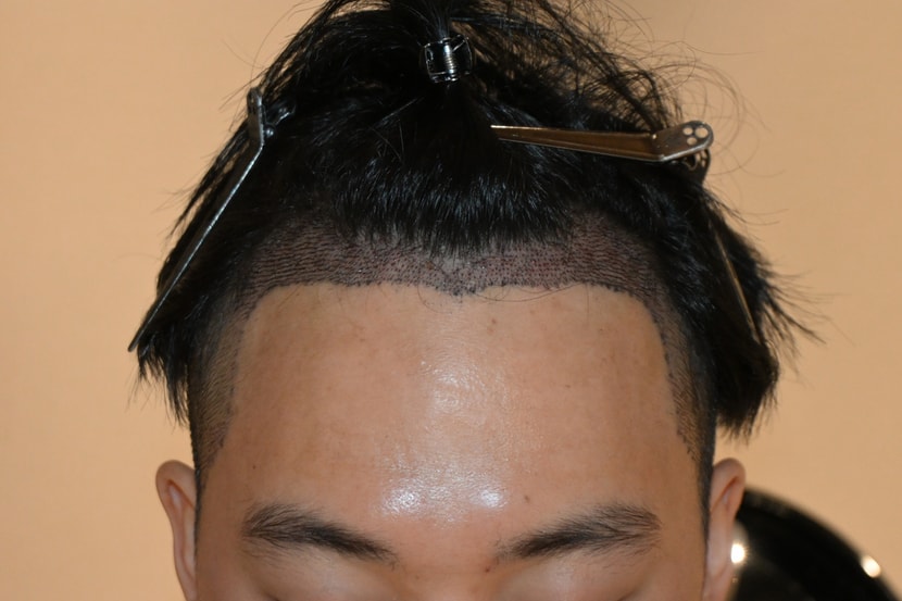수술후 2일차