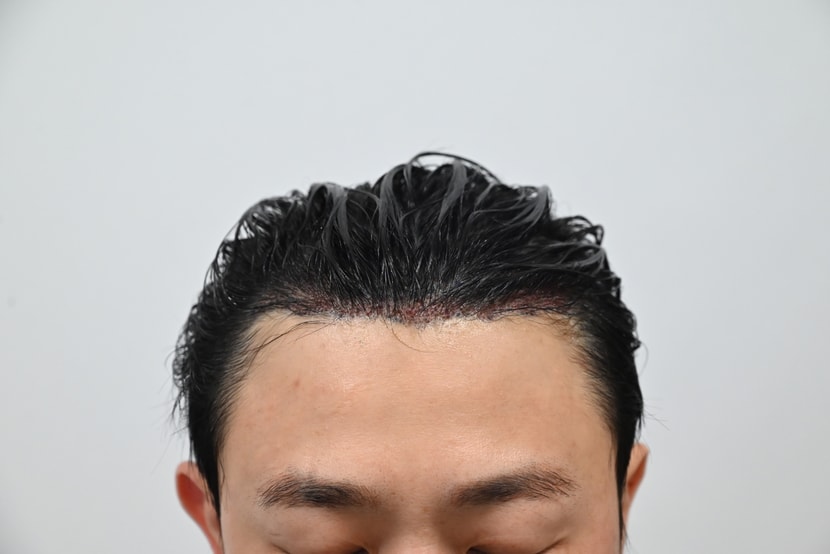 수술직후