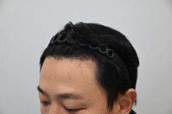 수술 3주차