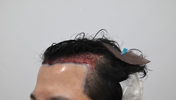 수술후