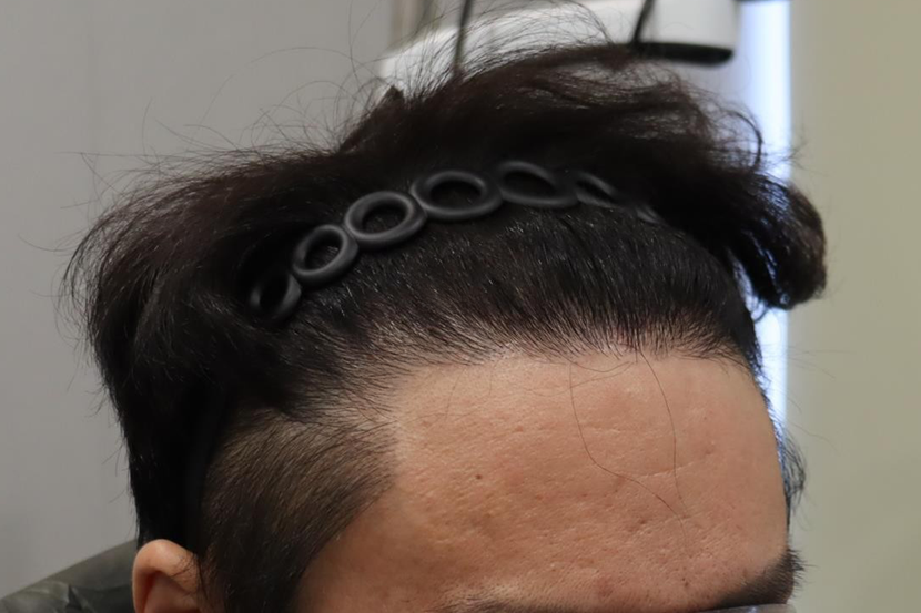 수술후