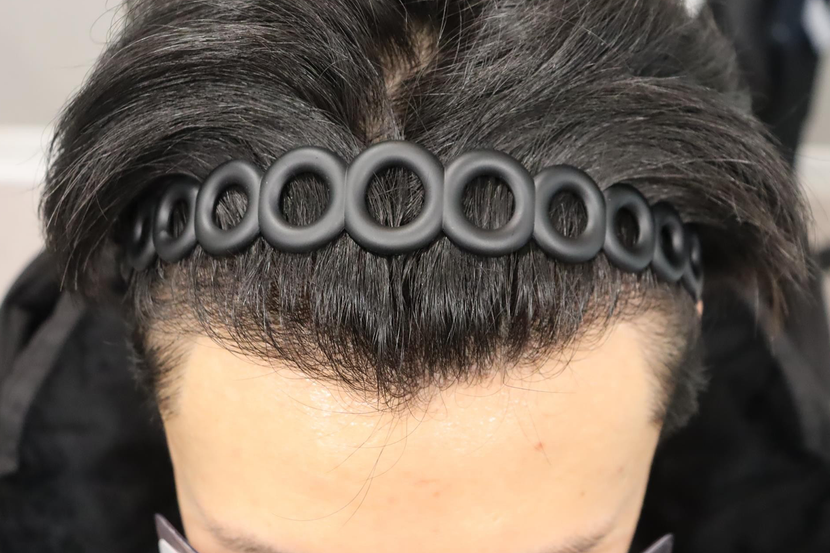 수술후
