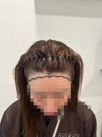 수술 당일 디자인 후