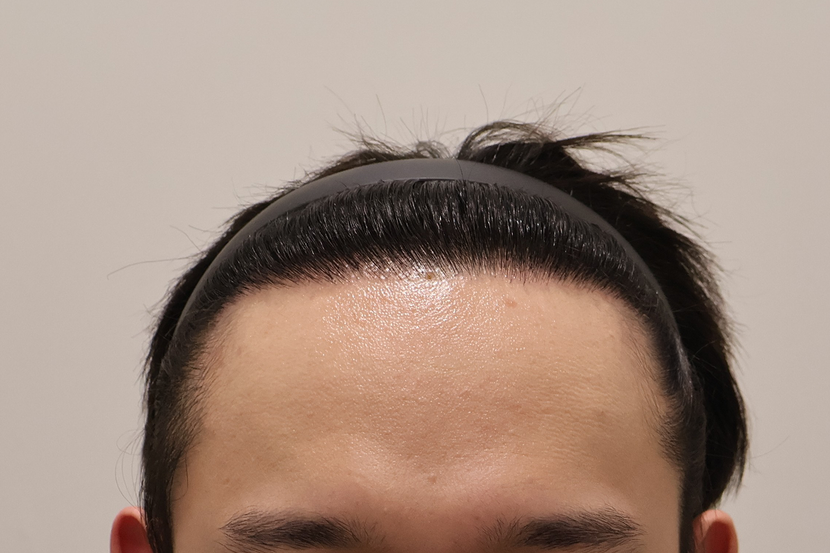 수술후