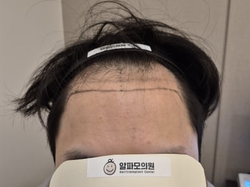 수술전