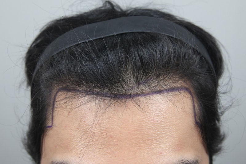모나라피부과_모발이식 (1).jpg