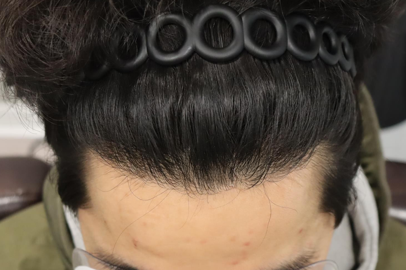 수술후