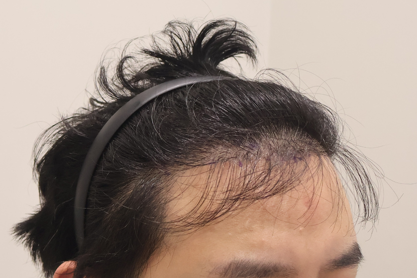 수술전