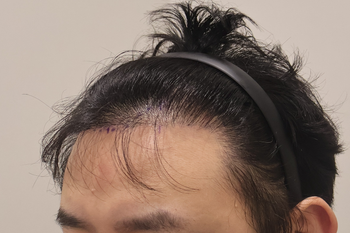수술전