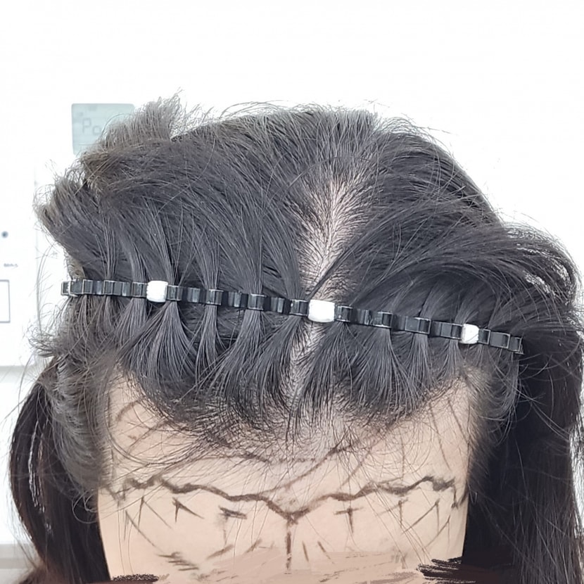 수술전