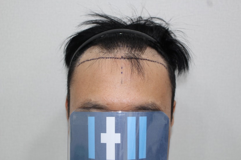 수술전
