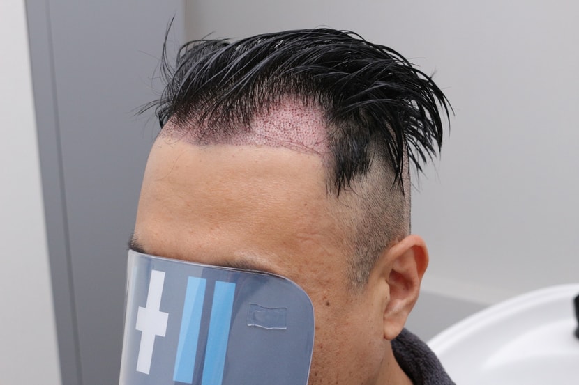 수술다음날