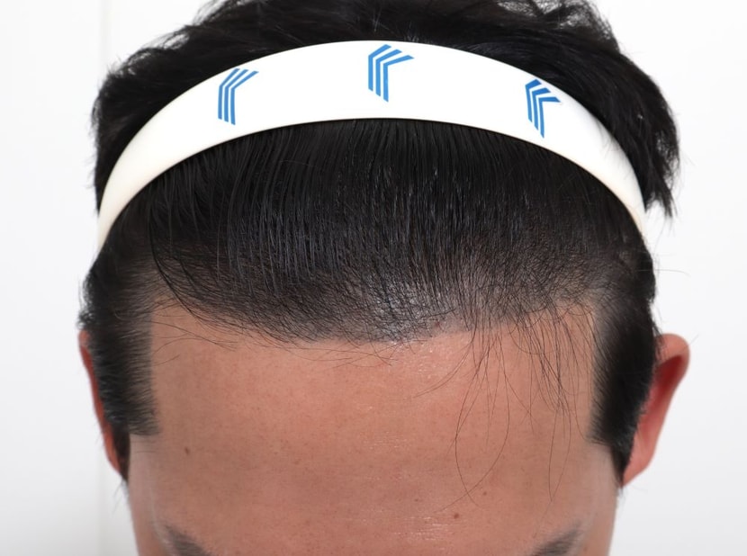 수술전