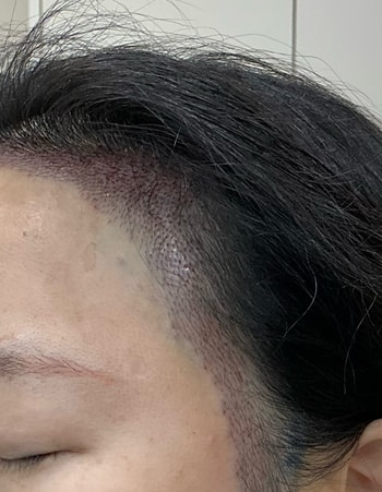 수술후 좌측