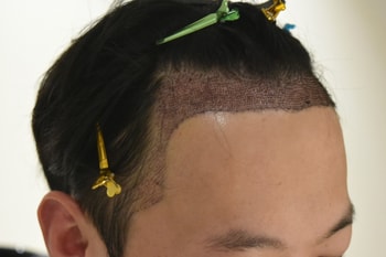 수술 후 2일차 샴푸 후
