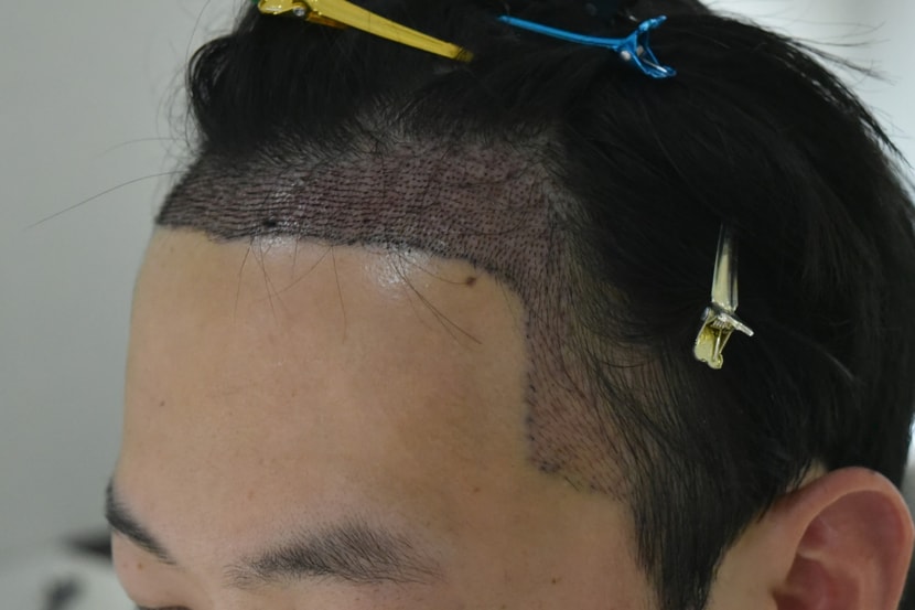 수술 후 2일차 샴푸 후