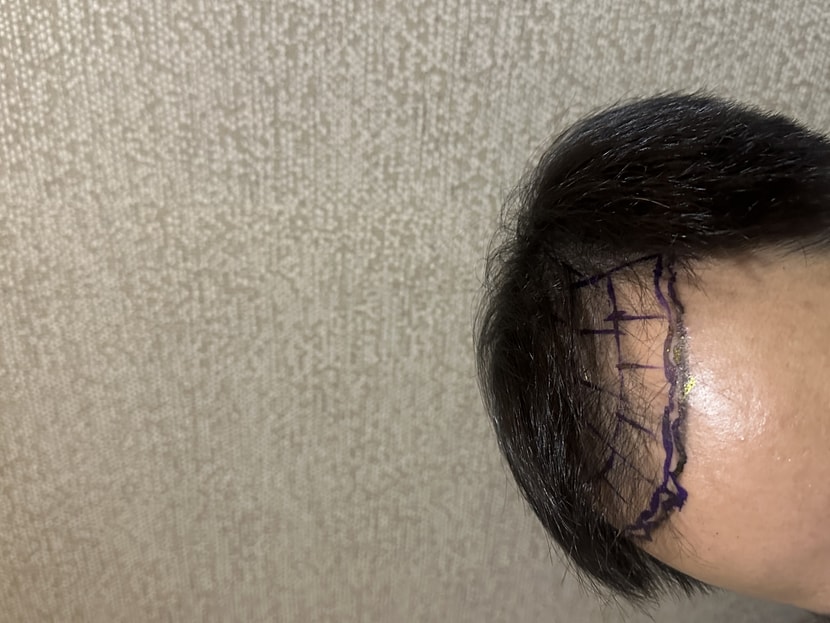 모발이식전