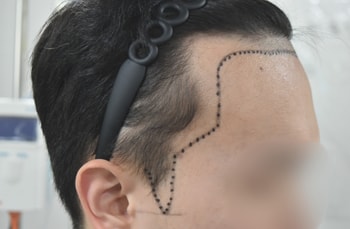 수술 전 우측