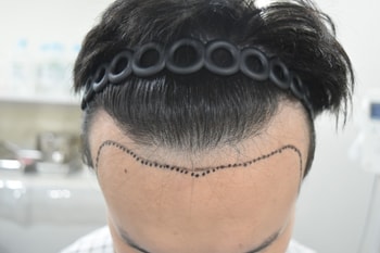 수술 전 정면