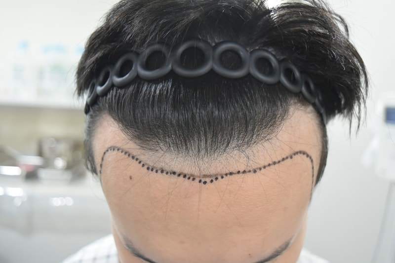 수술 전3.jpg