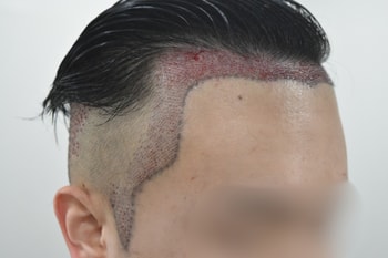 수술 직후 우측