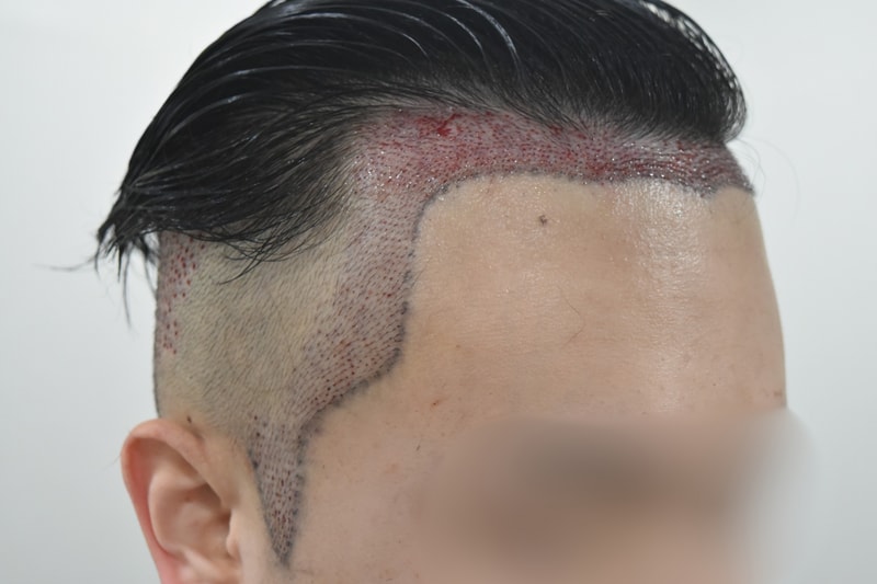 수술 후1.png
