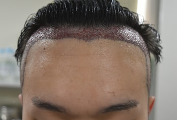 수술 직후 정면