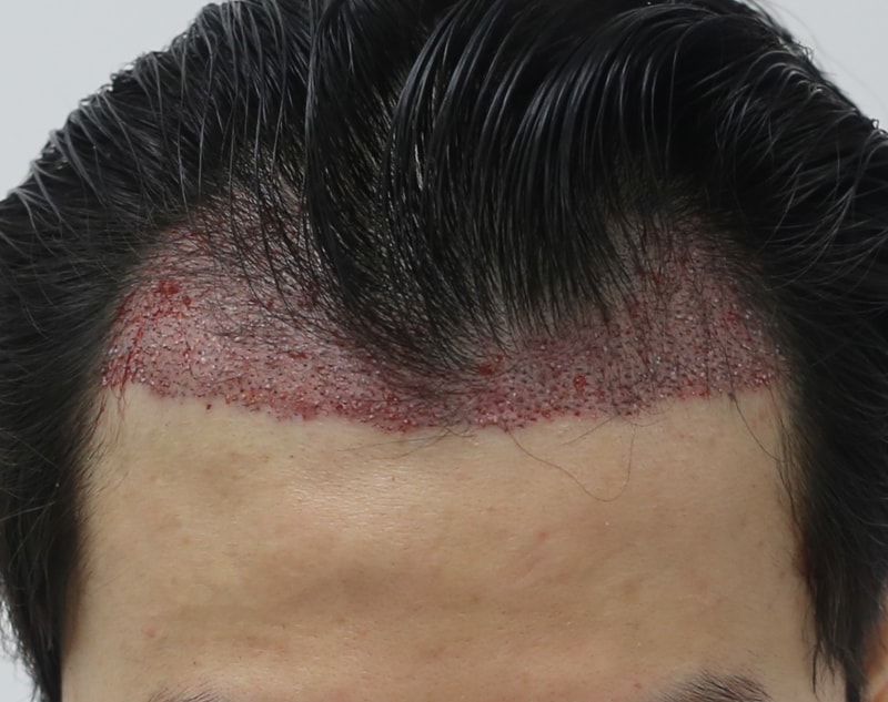 이규 수술후.JPG