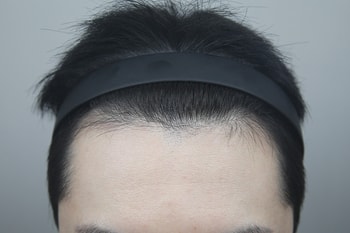수술 전