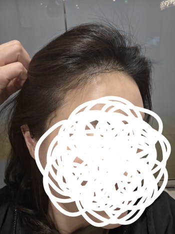 수술전 라인만 그린 상태