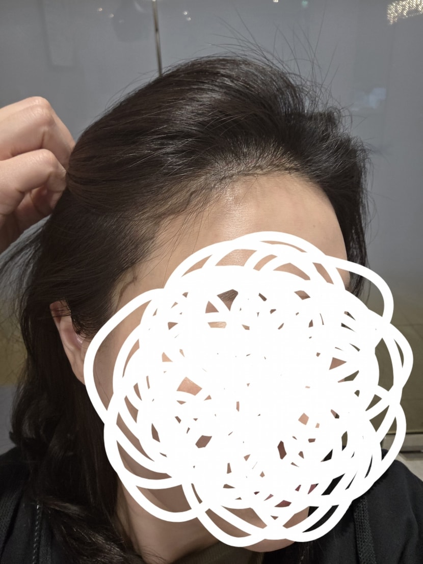 수술전 라인만 그린 상태