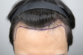 모발이식 디자인